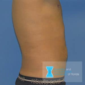 What areas of the body can be treated with liposuction